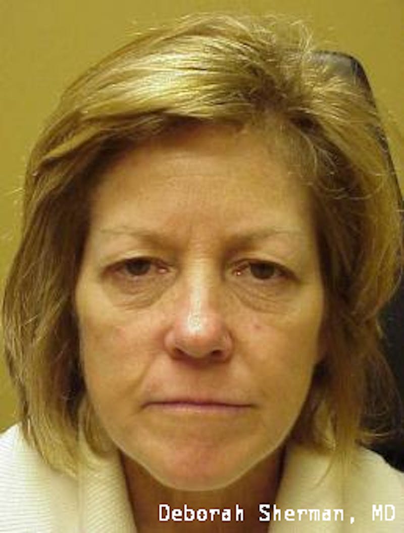 Endoscopic Brow Lift Before & After Gallery - Patient 181137 - Image 1