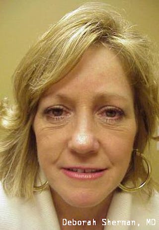 Endoscopic Brow Lift Before & After Gallery - Patient 181137 - Image 2