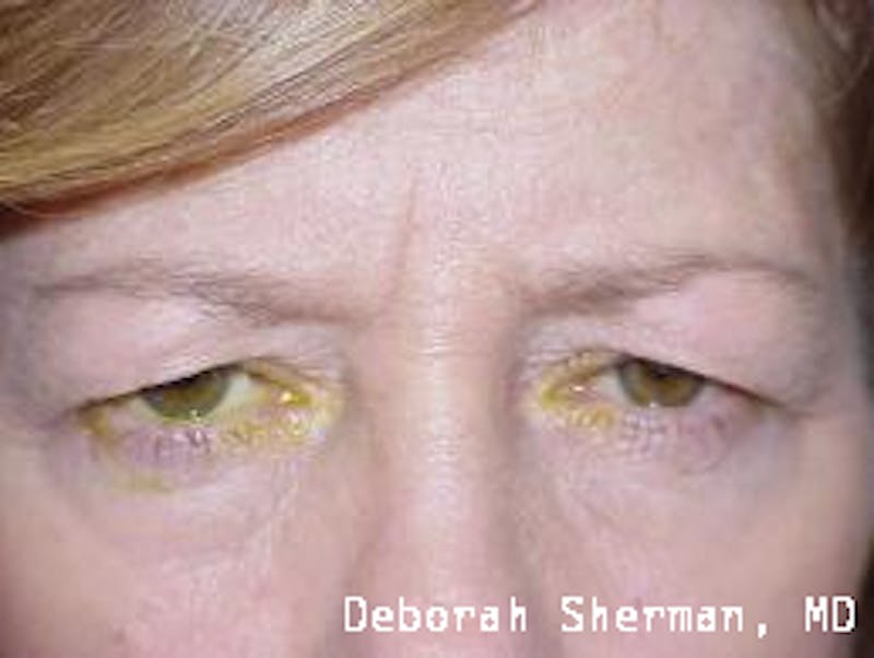 Endoscopic Brow Lift Before & After Gallery - Patient 181137 - Image 3
