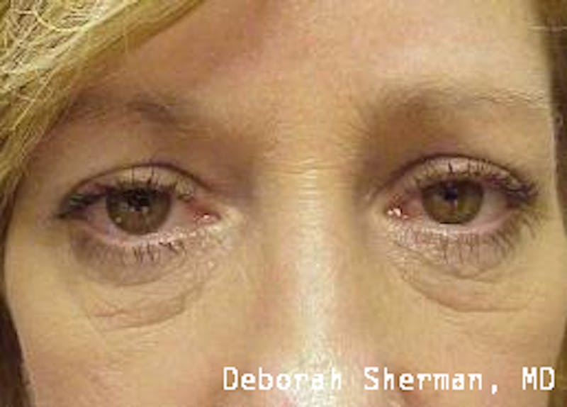 Endoscopic Brow Lift Before & After Gallery - Patient 181137 - Image 4