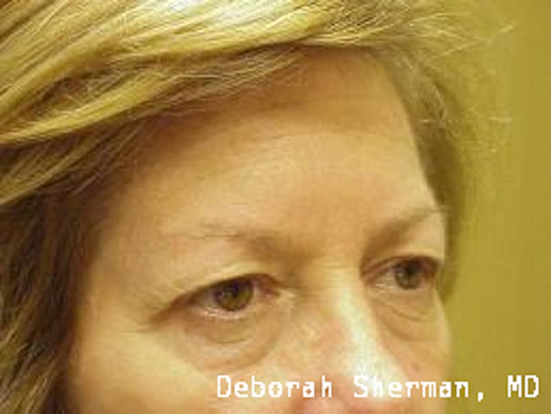 Endoscopic Brow Lift Before & After Gallery - Patient 181137 - Image 5