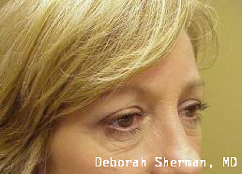 Endoscopic Brow Lift Before & After Gallery - Patient 181137 - Image 6