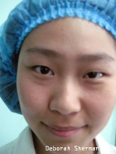 Double Eyelid Surgery Before & After Gallery - Patient 350999 - Image 1