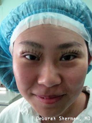 Double Eyelid Surgery Before & After Gallery - Patient 350999 - Image 2