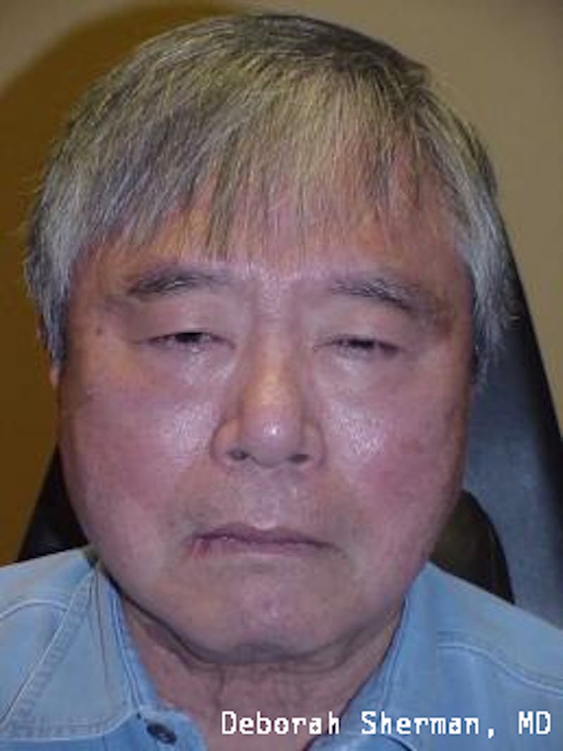 Double Eyelid Surgery Before & After Gallery - Patient 245910 - Image 1