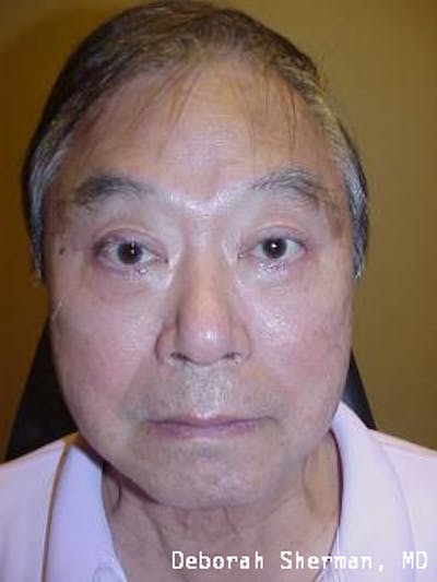 Double Eyelid Surgery Before & After Gallery - Patient 245910 - Image 2
