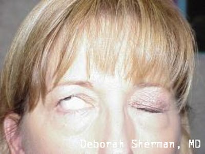 Lid Retraction Before & After Gallery - Patient 413590 - Image 1