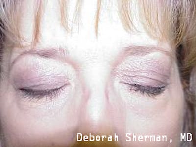 Lid Retraction Before & After Gallery - Patient 413590 - Image 2