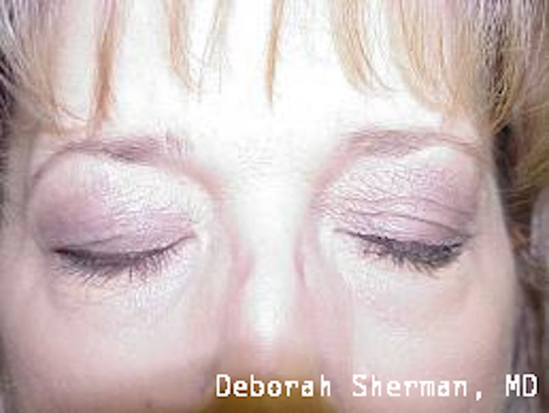 Lid Retraction Before & After Gallery - Patient 413590 - Image 2