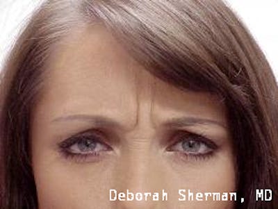 BOTOX Before & After Gallery - Patient 256706 - Image 1