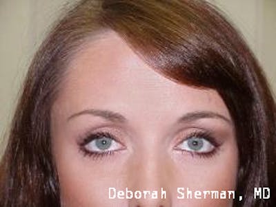 BOTOX Before & After Gallery - Patient 256706 - Image 2