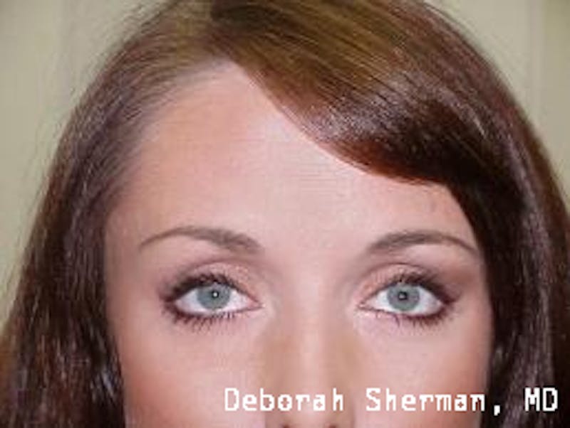 BOTOX Before & After Gallery - Patient 256706 - Image 2