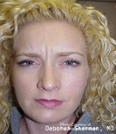 BOTOX Before & After Gallery - Patient 542144 - Image 1