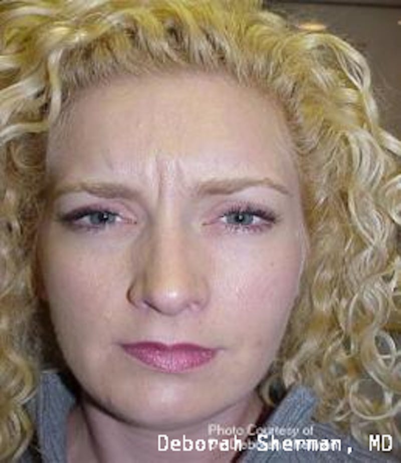 BOTOX Before & After Gallery - Patient 542144 - Image 1