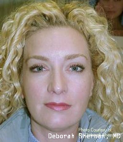 BOTOX Before & After Gallery - Patient 542144 - Image 2