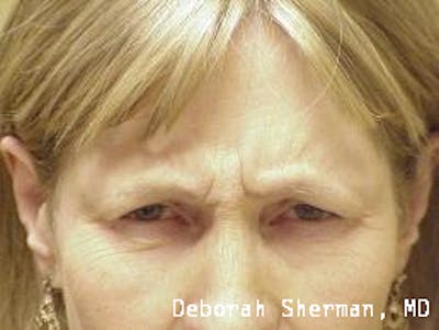 BOTOX Before & After Gallery - Patient 312670 - Image 1