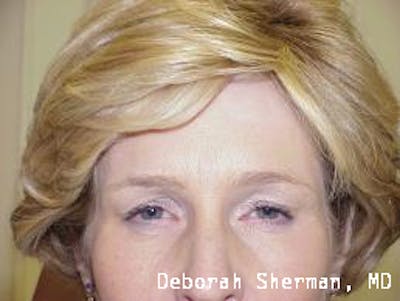 BOTOX Before & After Gallery - Patient 312670 - Image 2