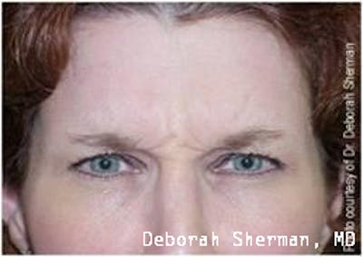 BOTOX Before & After Gallery - Patient 156401 - Image 1