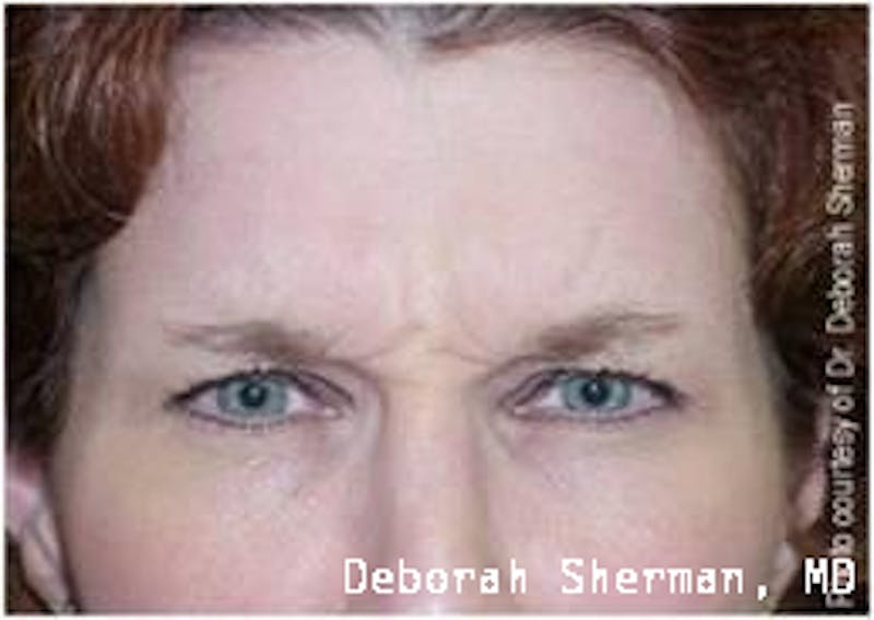 BOTOX Before & After Gallery - Patient 156401 - Image 1