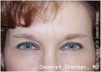 BOTOX Before & After Gallery - Patient 156401 - Image 2