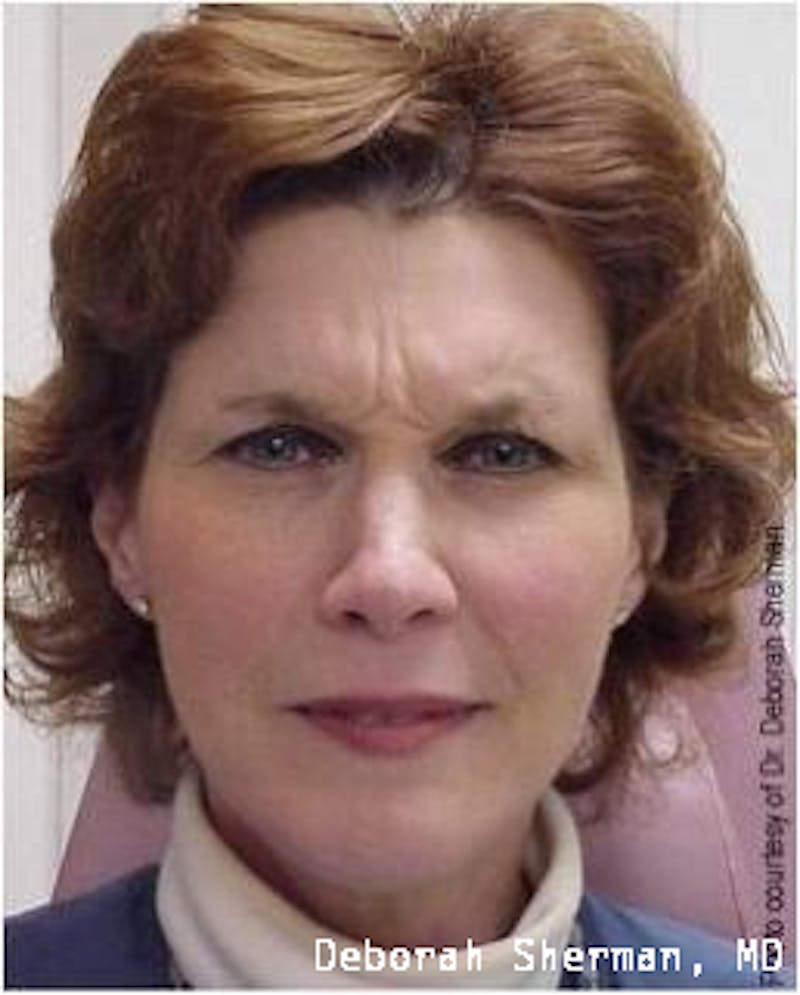 BOTOX Before & After Gallery - Patient 156401 - Image 3