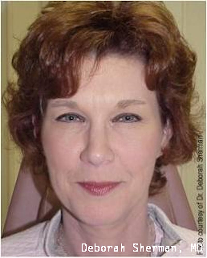 BOTOX Before & After Gallery - Patient 156401 - Image 4