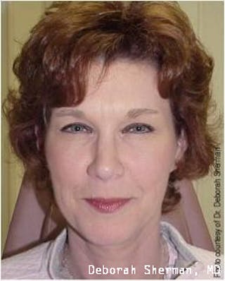 BOTOX Before & After Gallery - Patient 156401 - Image 4