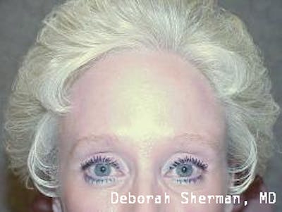 Dysport Before & After Gallery - Patient 100451 - Image 2