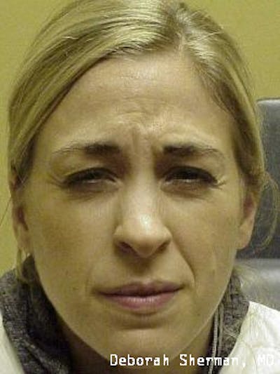 BOTOX Before & After Gallery - Patient 423120 - Image 1