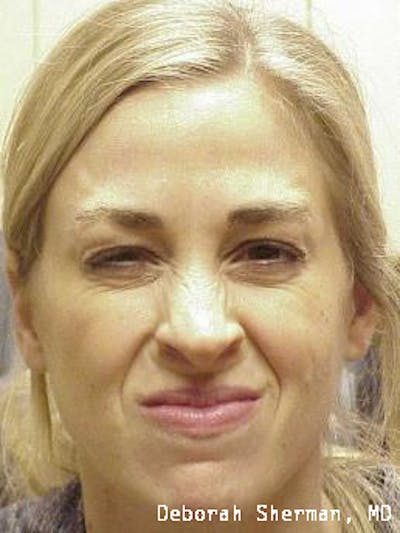 BOTOX Before & After Gallery - Patient 423120 - Image 2