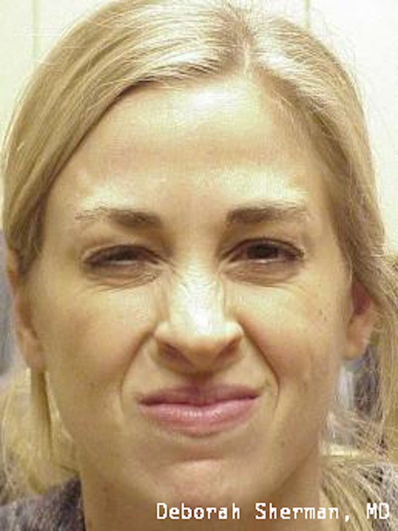 BOTOX Before & After Gallery - Patient 423120 - Image 2
