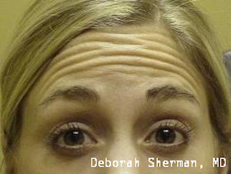 BOTOX Before & After Gallery - Patient 423120 - Image 3