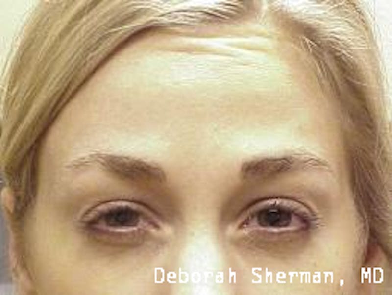 BOTOX Before & After Gallery - Patient 423120 - Image 4