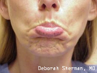 BOTOX Before & After Gallery - Patient 337359 - Image 1