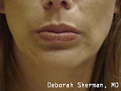 BOTOX Before & After Gallery - Patient 337359 - Image 2