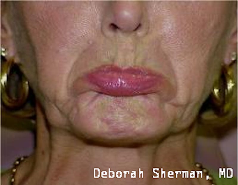 BOTOX Before & After Gallery - Patient 188453 - Image 1