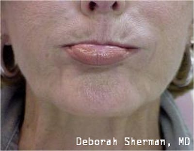BOTOX Before & After Gallery - Patient 188453 - Image 2