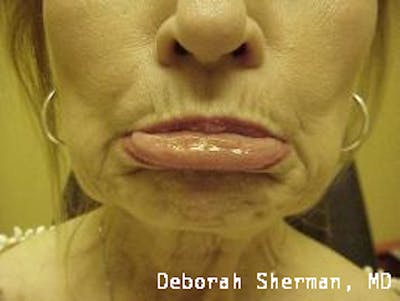 BOTOX Before & After Gallery - Patient 333663 - Image 1