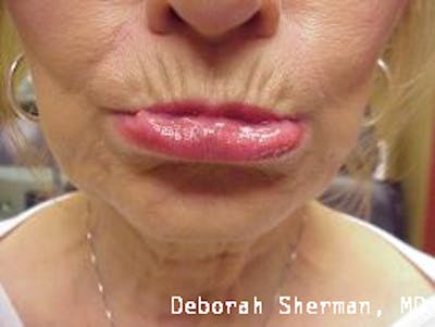 BOTOX Before & After Gallery - Patient 333663 - Image 2