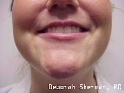BOTOX Before & After Gallery - Patient 643621 - Image 1