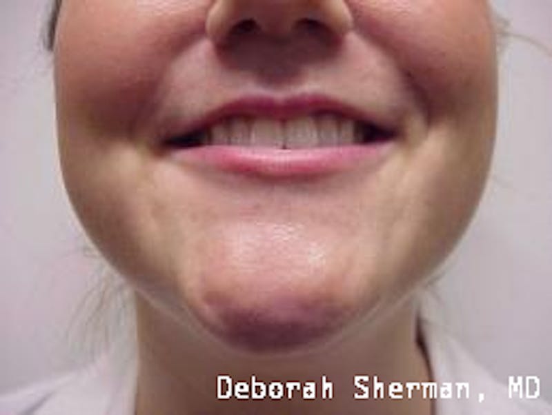BOTOX Before & After Gallery - Patient 643621 - Image 1