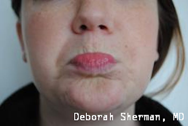 BOTOX Before & After Gallery - Patient 643621 - Image 4
