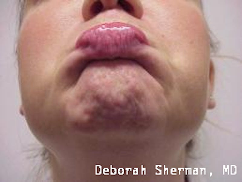 BOTOX Before & After Gallery - Patient 643621 - Image 5