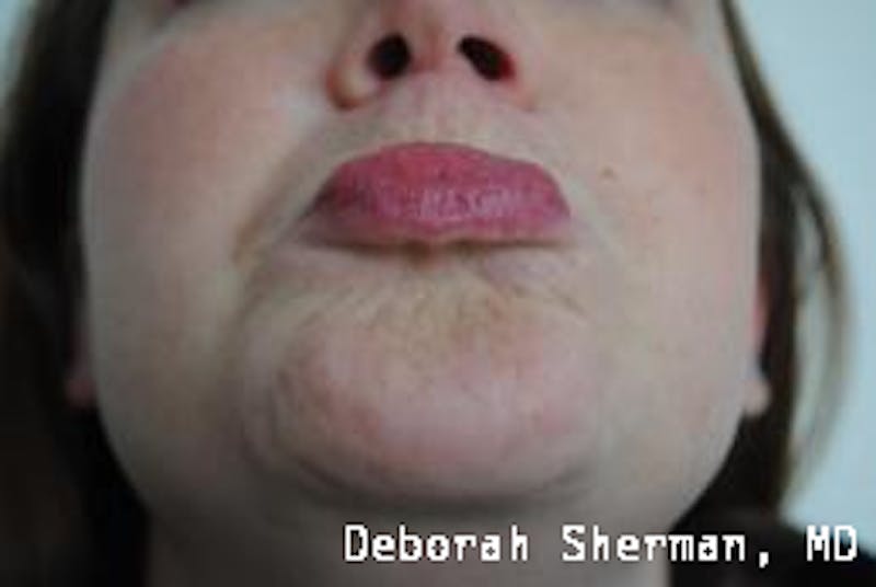 BOTOX Before & After Gallery - Patient 643621 - Image 6