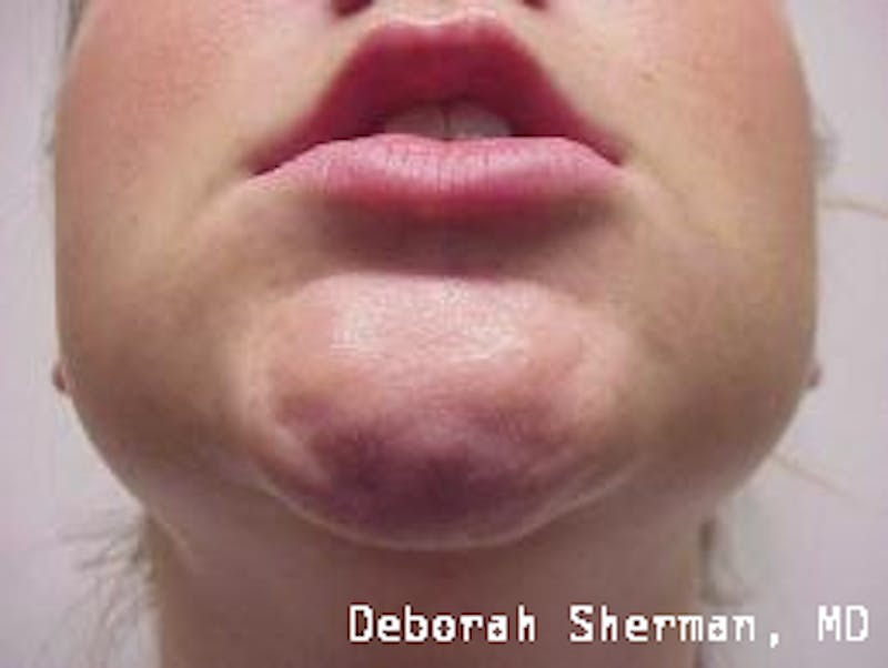 BOTOX Before & After Gallery - Patient 643621 - Image 7