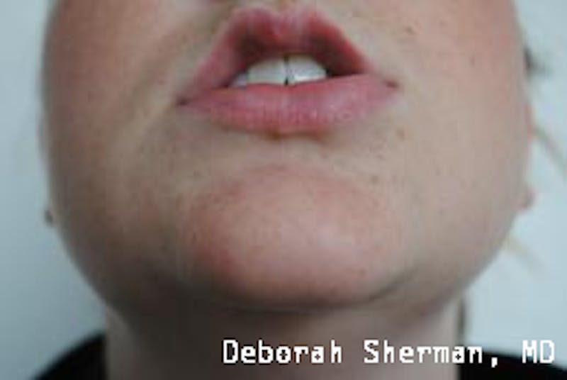 BOTOX Before & After Gallery - Patient 643621 - Image 8