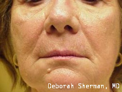 Facial Fillers Before & After Gallery - Patient 174743 - Image 1
