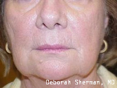 Facial Fillers Before & After Gallery - Patient 174743 - Image 2