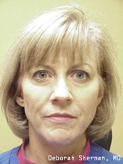 Facial Fillers Before & After Gallery - Patient 271067 - Image 1
