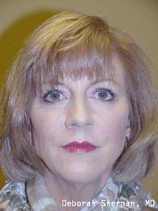 Facial Fillers Before & After Gallery - Patient 271067 - Image 2